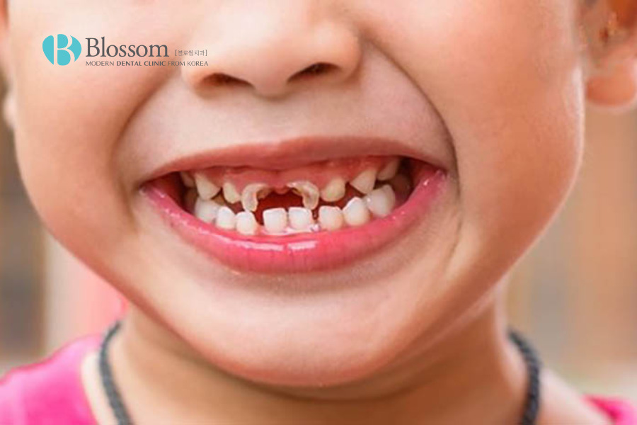Sâu chân răng khiến răng trở nên nhạy cảm hơn so với thông thường.