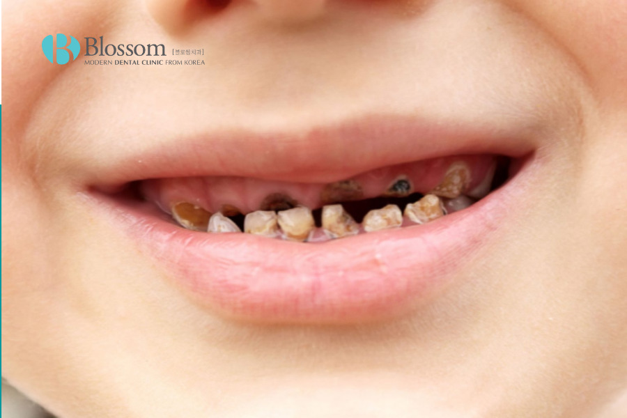 Sâu răng hàm gây đau nhức khó chịu kéo dài.