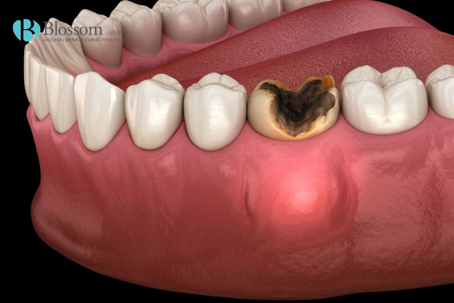 Sâu răng là một trong những nguyên nhân chính gây nên các ổ áp xe răng.