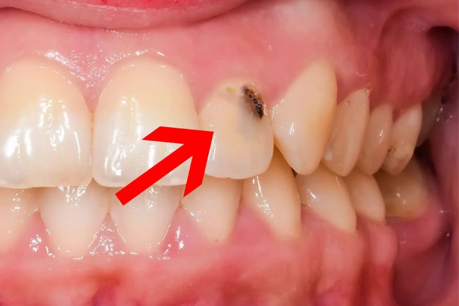 Sâu răng là nguyên nhân chính dễ dẫn tới đau nhức răng.