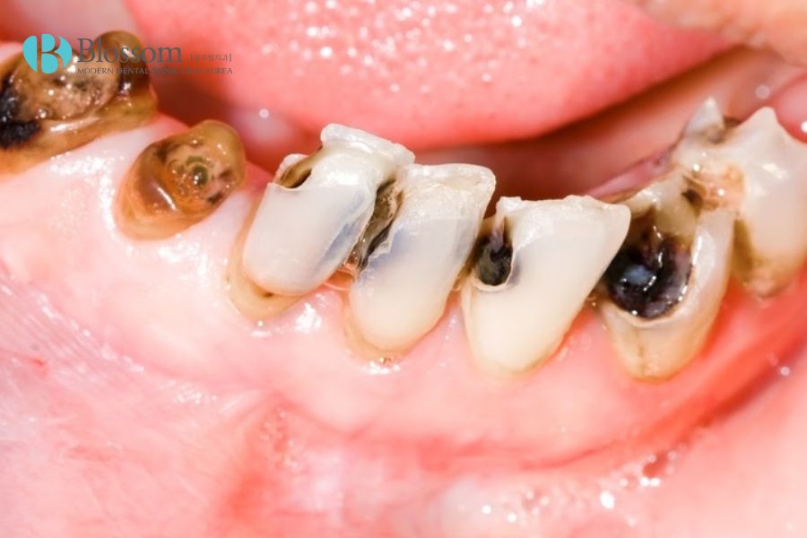 Sâu răng thường gặp ở trẻ nhỏ hơn người trưởng thành.