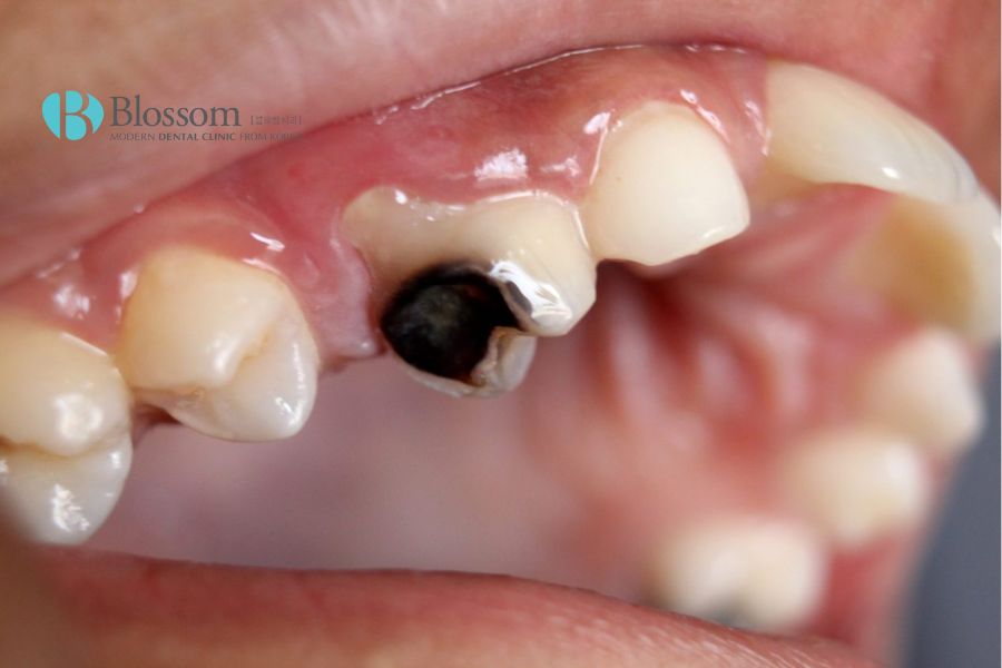 Sâu răng, viêm tủy,....là những biến chứng phổ biến khi bạn đau nhức răng kéo dài.