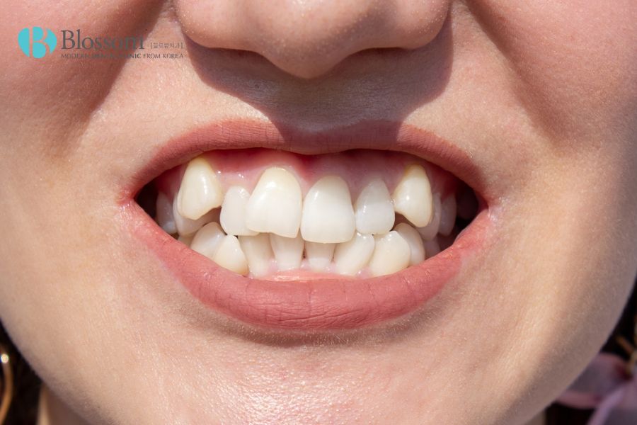 Sự xuất hiện của răng khểnh có thể do kích thước hàm nhỏ, không đổ chỗ để cho các răng mọc