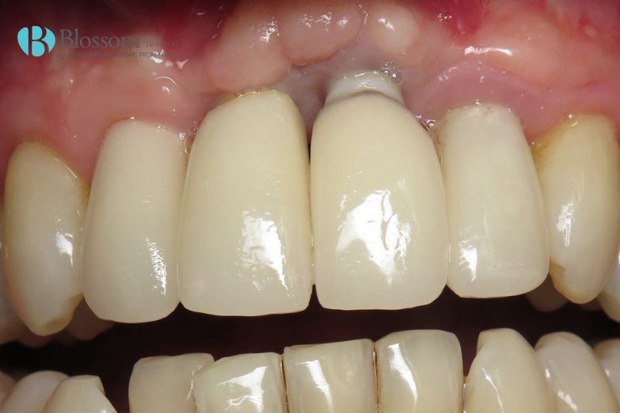 Thời gian trồng răng cửa với kỹ thuật cấy ghép Implant kéo dài từ 3 - 6 tháng