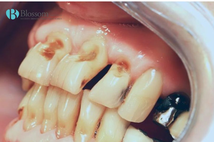 Thói quen chăm sóc răng miệng không đúng cách có thể gây ra mòn chân răng.