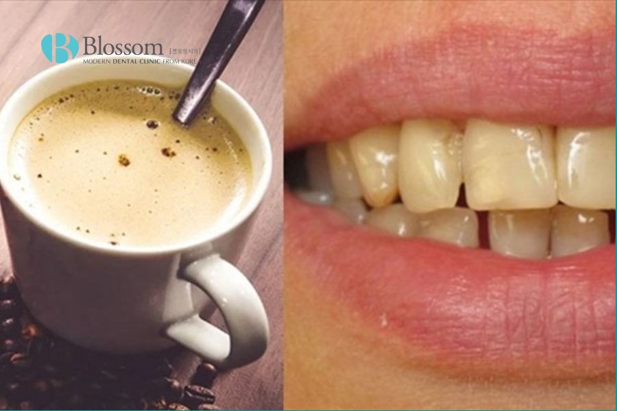 Thuốc lá, trà, cafe là nguyên nhân khiến răng xỉn màu.