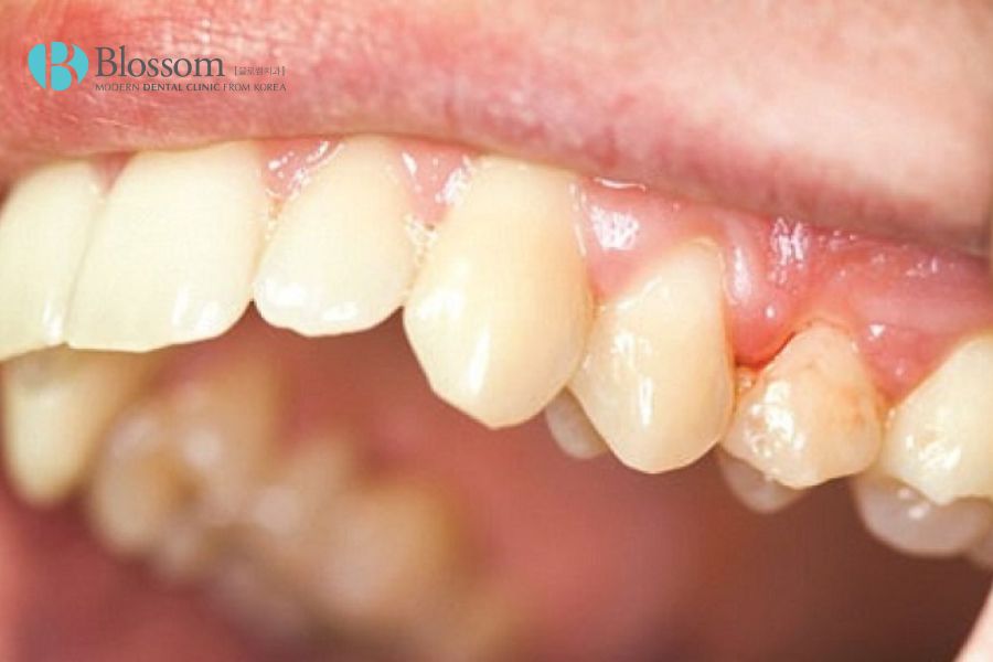 Tiêu xương hàm dẫn đến việc răng không khỏe mạnh sau khi cấy ghép Implant