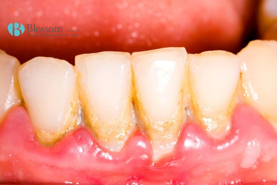 Tình trạng mòn men răng khi diễn ra ở giai đoạn sau dễ dẫn tới cảm giác đau nhức.