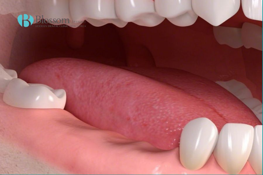 Tình trạng răng miệng và chất lượng xương hàm ảnh hưởng trực tiếp đến thời gian trồng Implant.