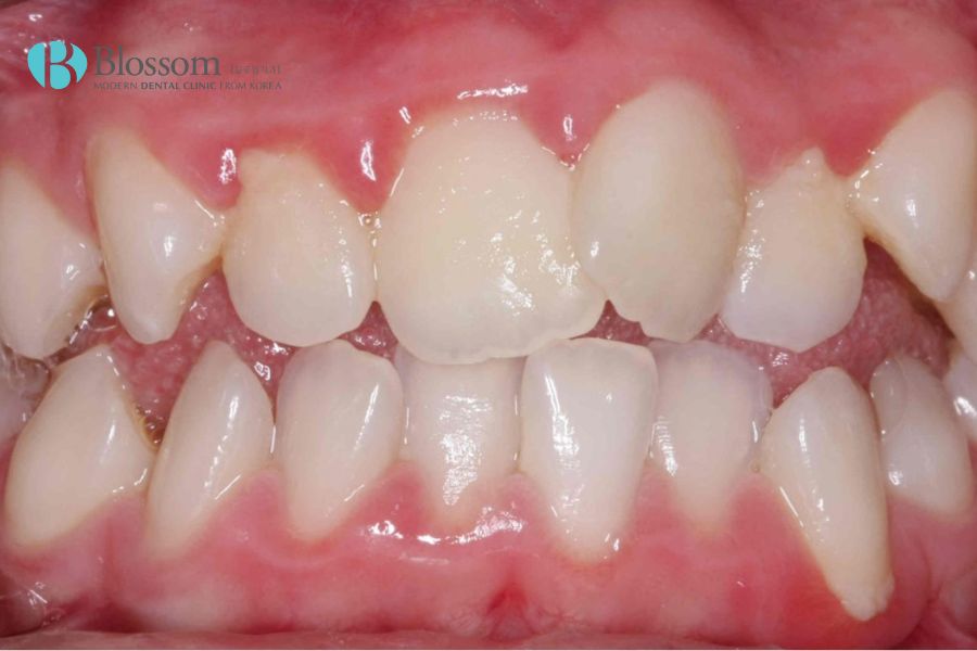 Tình trạng răng xô lệch rất thường gặp khiến hàm răng khó nhai nghiền thức ăn.