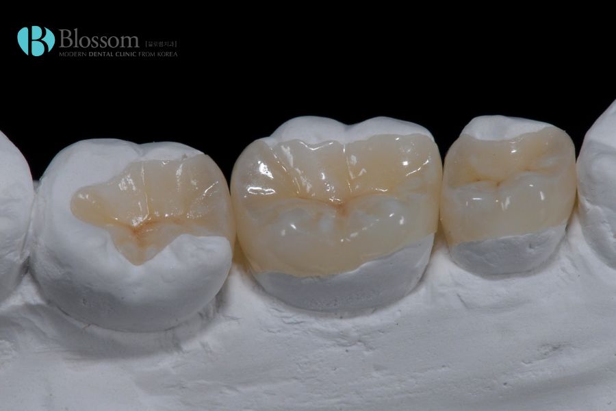 Trám răng bị sâu với phương pháp onlay, inlay có độ bền cao, ngăn ngừa vi khuẩn xâm nhập