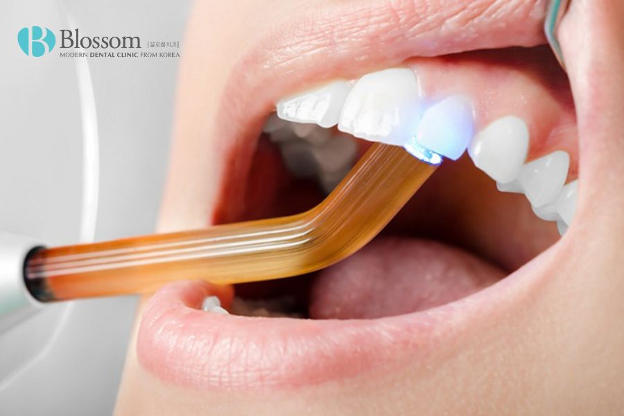 Trám răng là phương pháp phục hình răng cửa bị mẻ có chi phí khá rẻ.