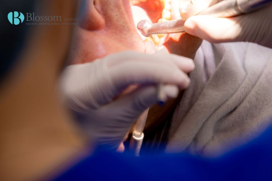 Trong giai đoạn mòn cổ chân răng nặng có thể cần can thiệp chữa viêm tủy răng