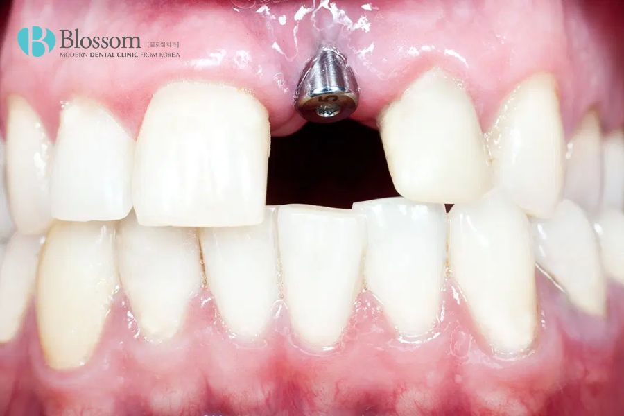 Trồng răng cửa bằng cấy ghép Implant có giá chênh lệch, tùy vào chất liệu, cơ sở nha khoa thực hiện,...