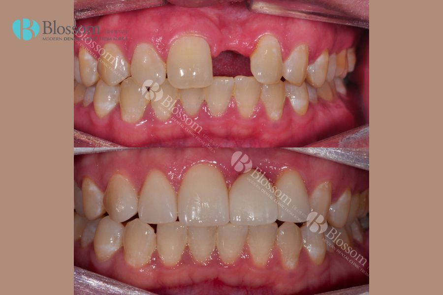 Trồng răng cửa hỗ trợ khả năng ăn nhai tốt hơn
