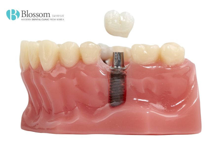 Trồng răng hàm có thể mất khoảng thời gian từ 4 tháng - 1 năm