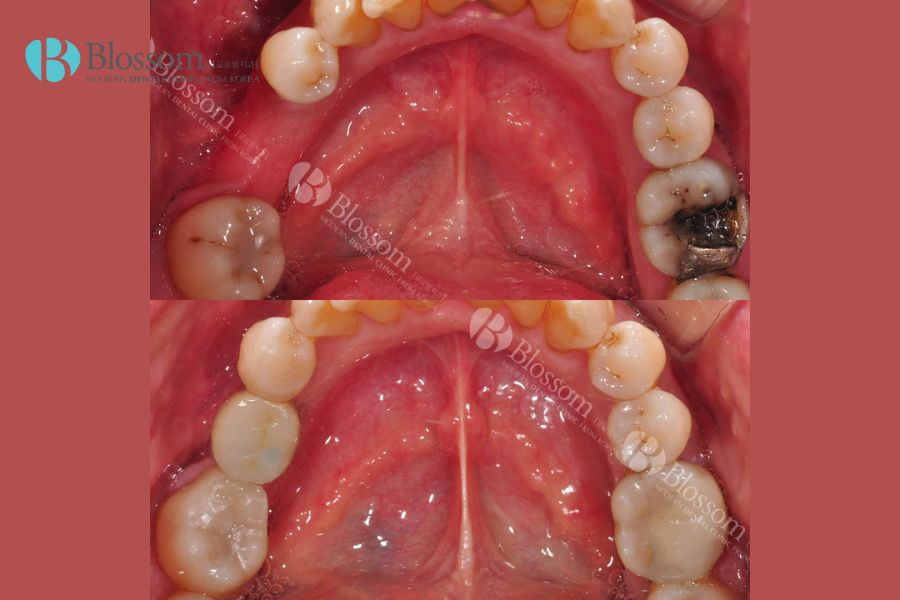 Trồng răng hàm Implant tại Nha Khoa Blossom an toàn với vật liệu cao cấp