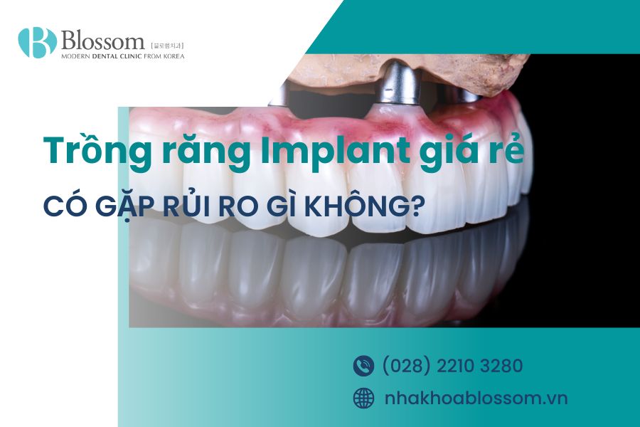 Trồng răng Implant giá rẻ có tốt không? Có gặp rủi ro gì không?