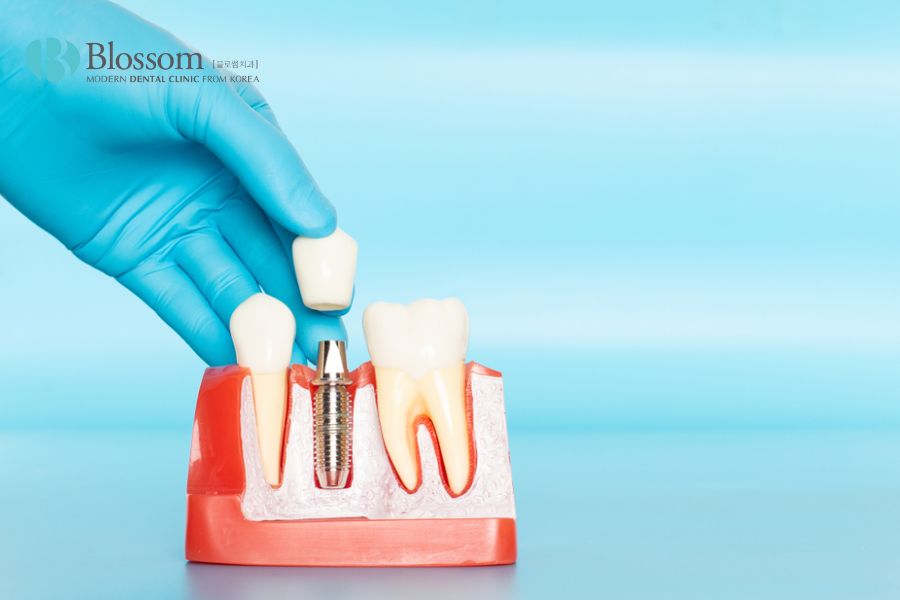Trồng răng Implant kém chất lượng sẽ dễ khiến Implant bị đào thải
