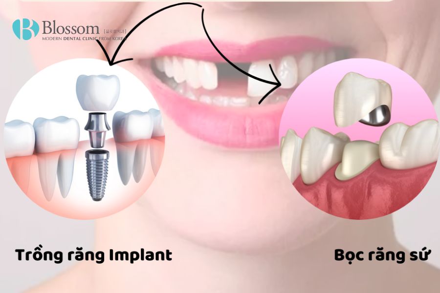 Trồng răng Implant là kỹ thuật phục hình nha khoa mang tính hiệu quả cao.