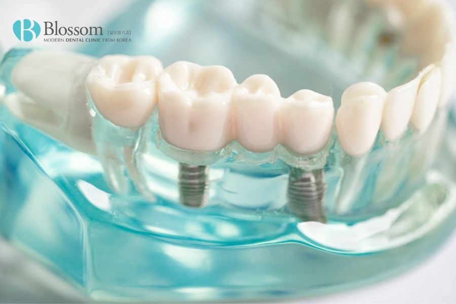 Trồng răng Implant là phương pháp hiệu quả giúp giải quyết tình trạng tiêu xương hàm