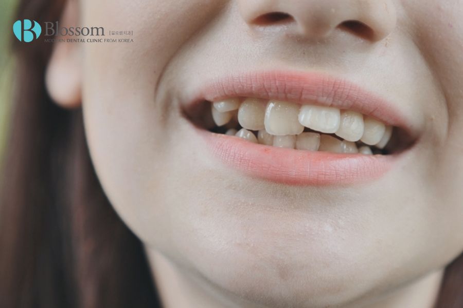 Trồng răng khểnh bằng cách đắp composite cho răng trắng sáng, tự nhiên