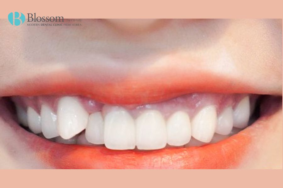 Trồng răng khểnh đẹp, độ bền cao với phương pháp Implant tại Nha Khoa Blossom