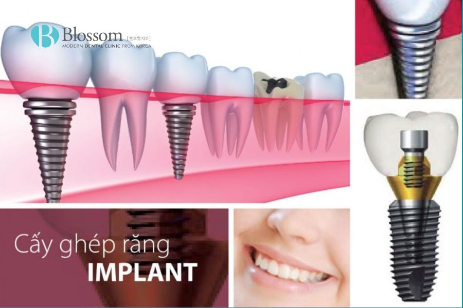 Trụ Implant có khả năng chịu lực gấp nhiều lần so với răng thật.