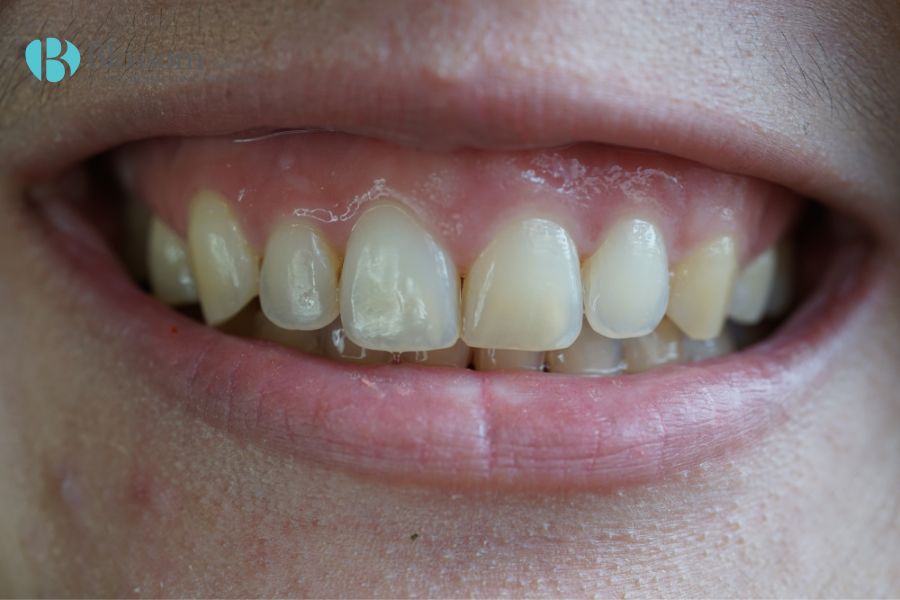 Vấn đề cười hở lợi có thể do răng hàm trên mọc không đồng đều