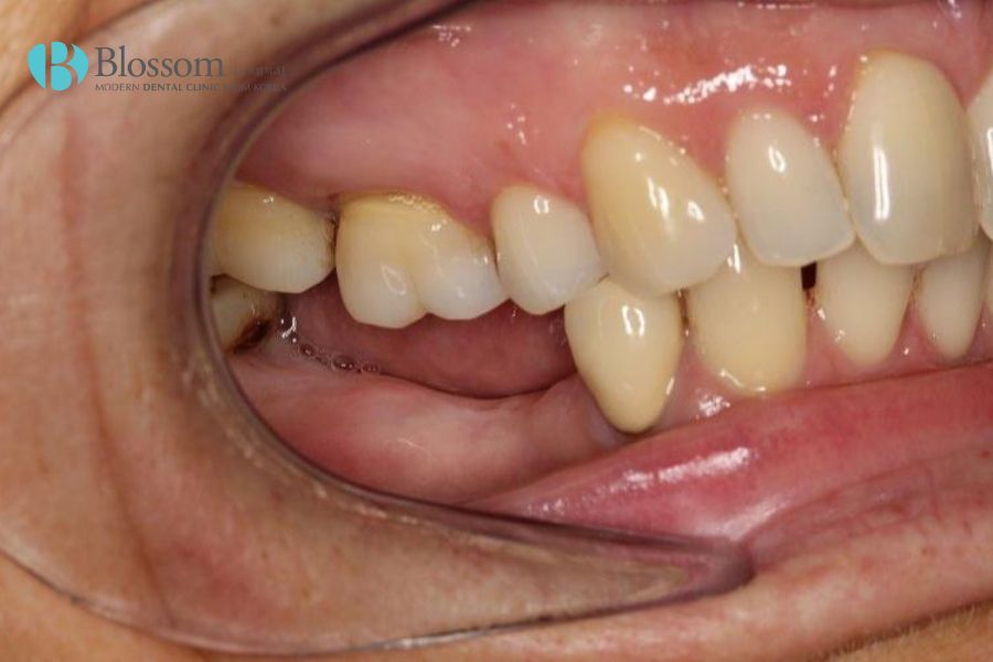 Vấn đề tiêu xương hàm dễ xảy ra khi răng xuất hiện khoảng trống hoặc bị vi khuẩn tấn công