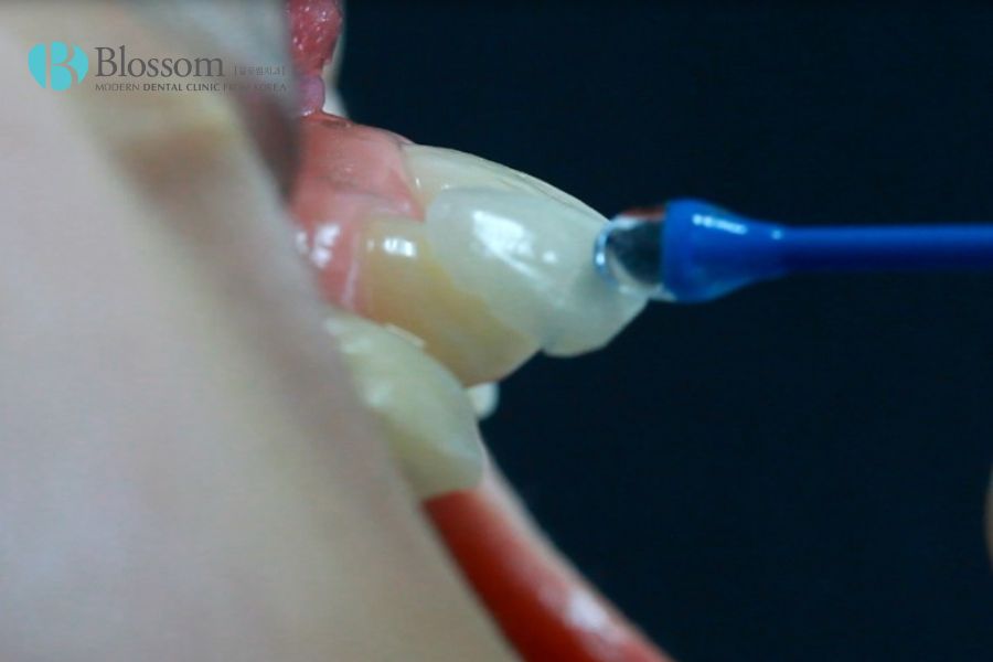 Vật liệu sứ đóng vai trò quan trọng, đảm bảo làm răng sứ chất lượng