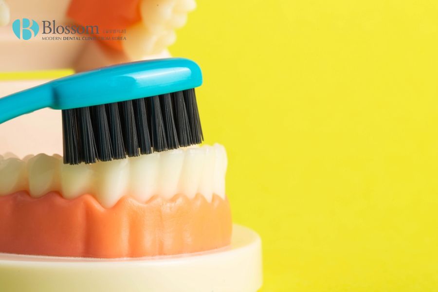Vệ sinh răng miệng không đúng cách là một trong những trường hợp dẫn đến răng bị mòn