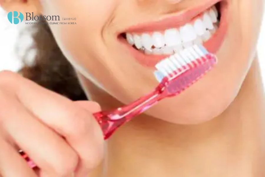 Vệ sinh răng miệng sạch sẽ với bàn chải lông mềm để loại bỏ mảng bám sau khi trồng răng cửa