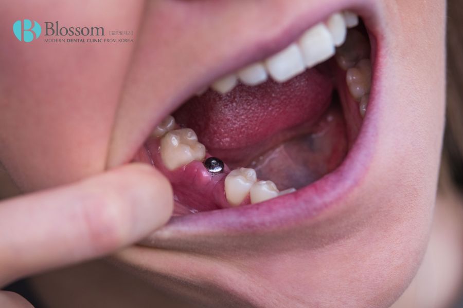 Việc cấy ghép Implant sớm cũng là giải pháp tối ưu chi phí khi không phải xử lý hiện tượng xô lệch vị trí của các răng