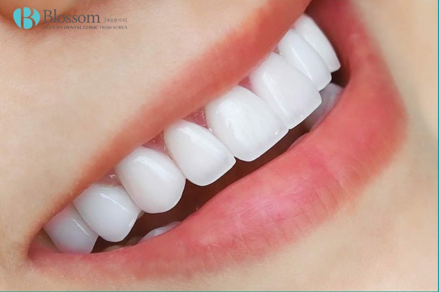 Việc điều trị răng ố vàng nên chọn địa điểm nha khoa uy tín để đạt kết quả tốt nhất.