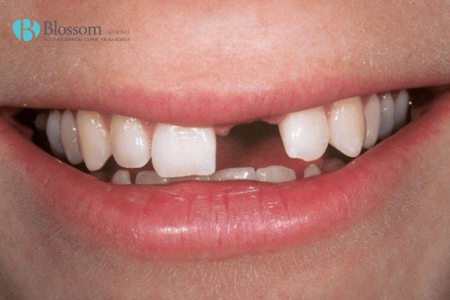 Việc mất răng có thể dẫn đến tình trạng tiêu xương hàm