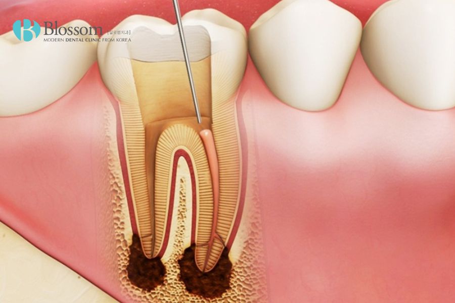 Viêm tủy răng không được xử lý kịp thời có thể gây nhiều hệ lụy nguy hiểm.