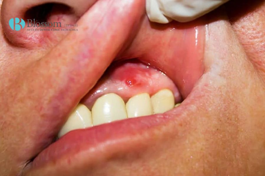 Áp xe răng rất dễ gây chảy máu tại nướu, lợi.