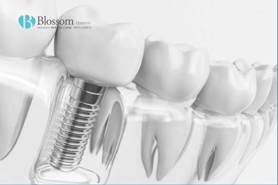 Blossom sử dụng trụ Implant cao cấp, chính hãng từ các thương hiệu uy tín trên thế giới.