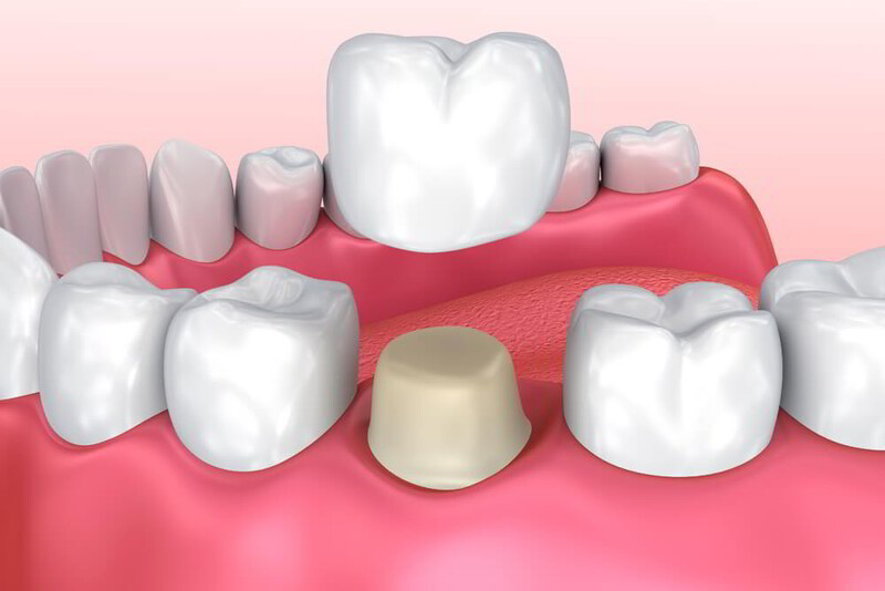 Bọc răng sứ là phương pháp sử dụng mão răng sứ giúp phục hồi chức năng ăn nhai và thẩm mỹ.