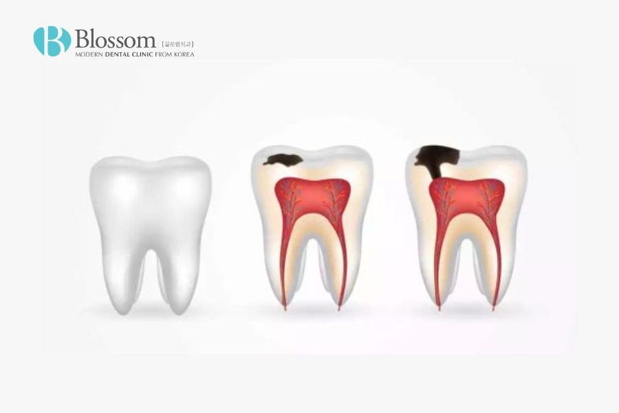 Các mức độ sâu răng sẽ tiến triển theo thời gian nếu không được điều trị đúng cách.