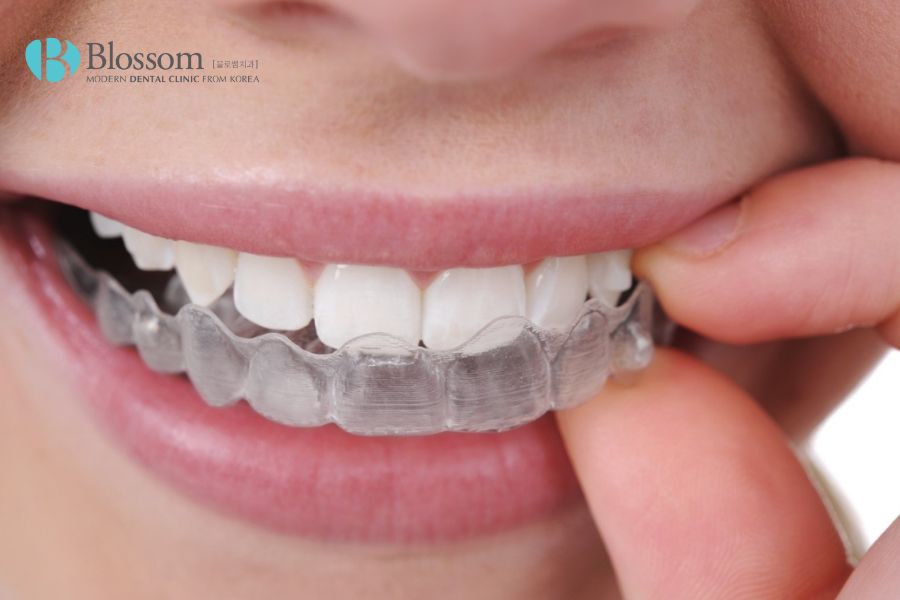Để đeo máng răng phù hợp bạn nên đến thăm khám và tuân theo chỉ định nha khoa.