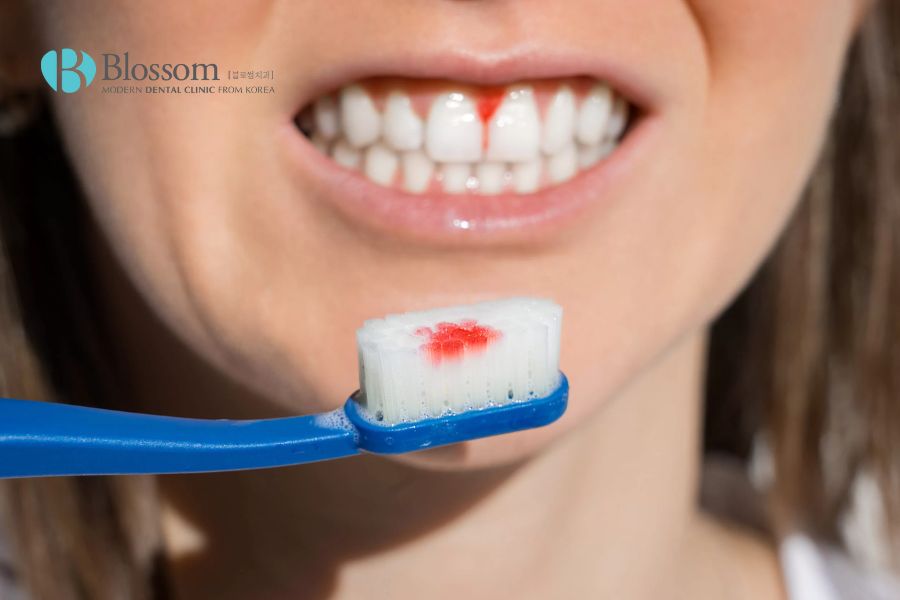 Cần thay đổi thói quen để hạn chế chảy máu tại chân răng.