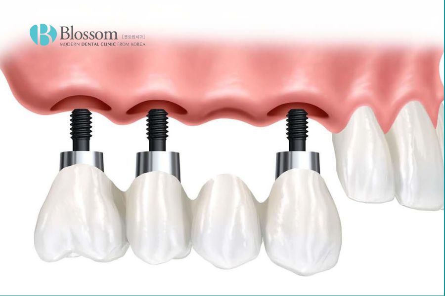 Cầu răng sứ trên Implant là phương pháp phục hình cho trường hợp mất 3 răng liên tiếp.