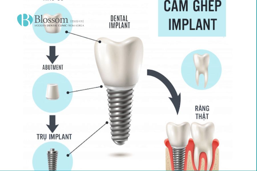 Cấu tạo trụ Implant gồm 3 phần chính: trụ implant, khớp nối abutment và mão sứ.