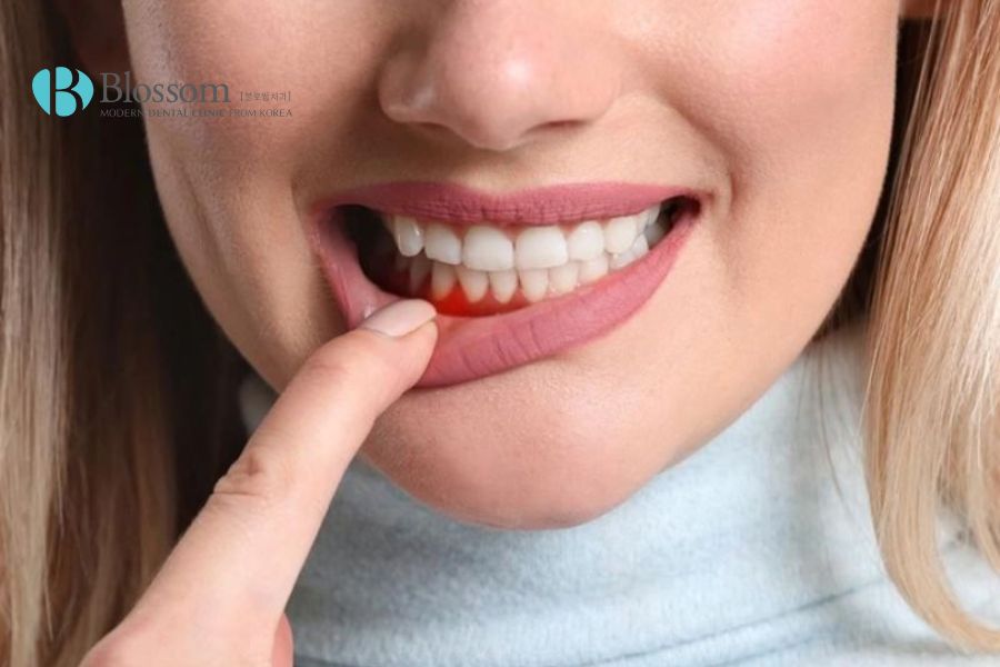 Chảy máu chân răng có thể gây nên nhiều biến chứng nguy hiểm.