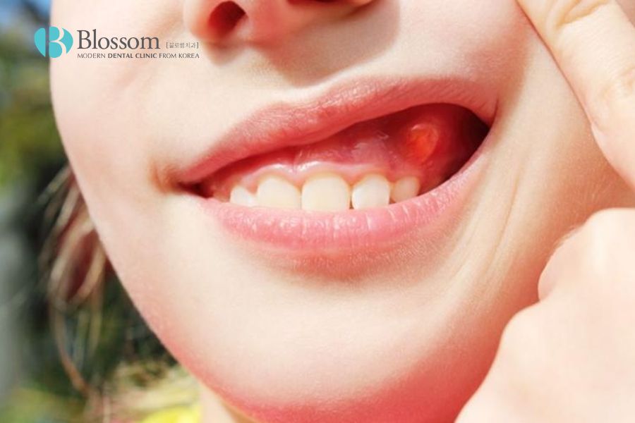 Chứng áp xe răng không chỉ gây chảy máu mà còn gây ra cảm giác đau buốt.