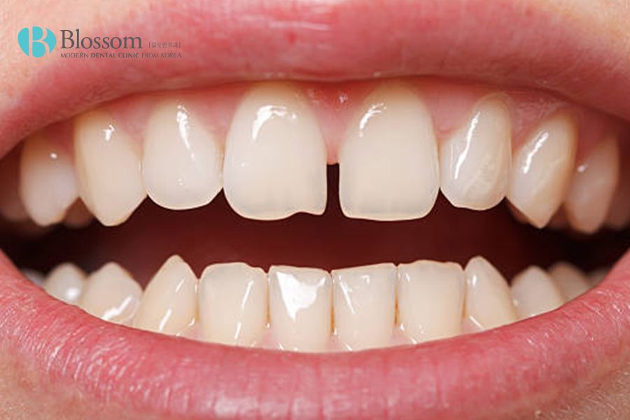 Có nhiều nguyên nhân có thể gây ra tình trạng răng thưa.