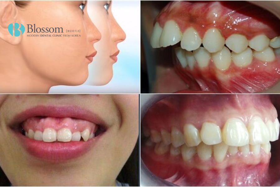 Có nhiều nguyên nhân dẫn đến hô hàm và hô răng.