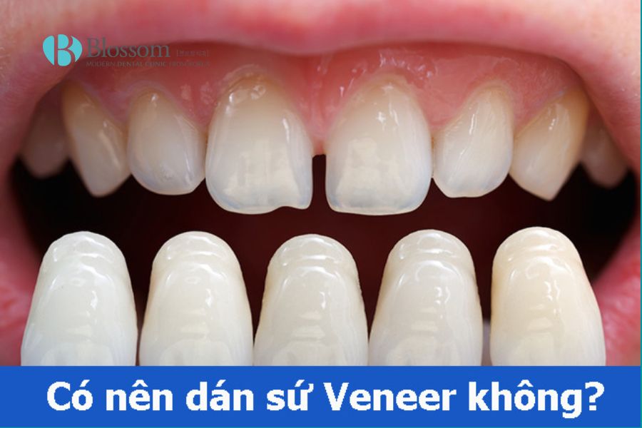 Dán sứ Veneer là kỹ thuật sử dụng mặt dán sứ mỏng để che đi các khuyết điểm của răng.